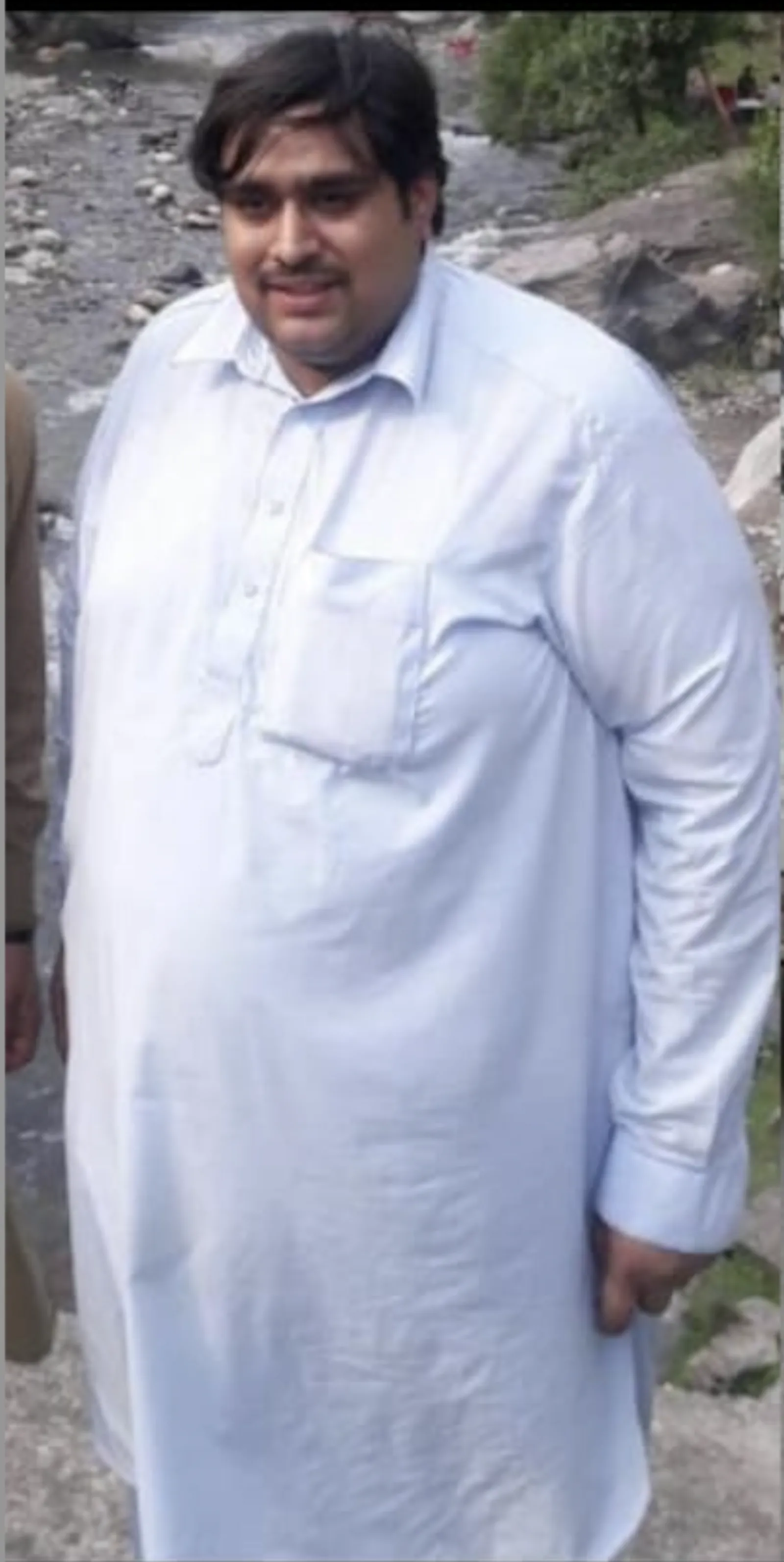 Patient before bariatric surgery